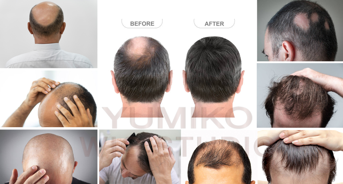 วิกผมแท้ ผู้ชาย วิกปิดหัวล้าน วิกผมแท้ทอมือ แก้ปัญหาผมล้าน Yumiko Wig Studio