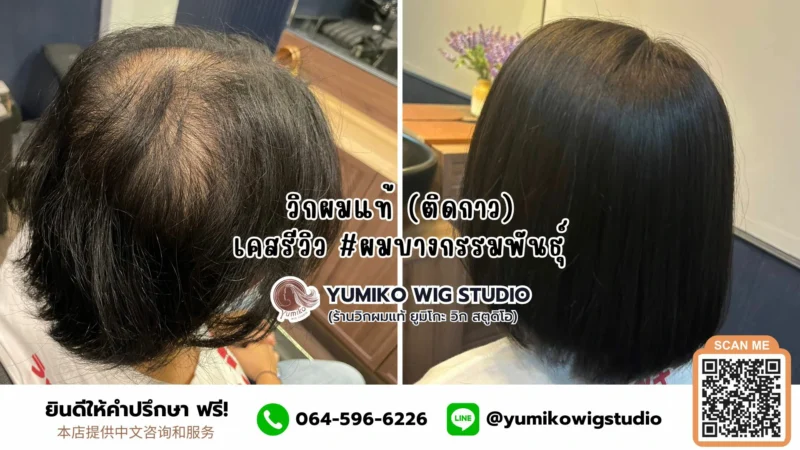 วิกผมแท้ ทอมือ วิกติดกาว เคสรีวิว ผมบางกรรมพันธุ์ Yumiko Wig Studio_5