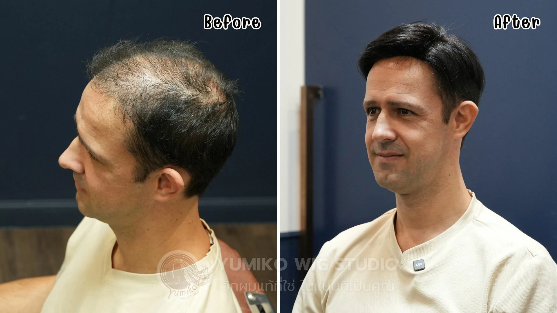 รีวิว วิกผมแท้ Yumiko หมดกังวลเรื่องผมบาง ศีรษะล้าน รู้สึกมั่นใจอีกครั้ง วิกผมผู้ชาย